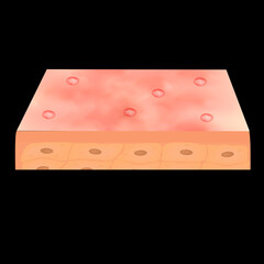 Cyst acne. Acne on the skin of a cyst. Dermatological and cosmetic diseases on the skin of the face. Infographics. Vector illustration on isolated background.