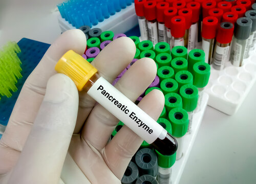 Test tube with blood sample for pancreatic enzyme test, amylase, lipase