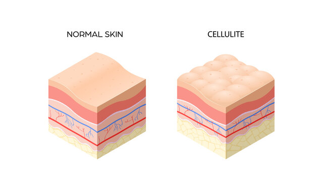 skin with cellulite and normal skin cross-section of human skin layers structure skincare medical concept flat horizontal