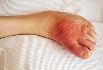 erysipelas of the legs, red rash on the legs.selective focus