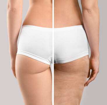 Young woman before and after anti-cellulite treatment on grey background