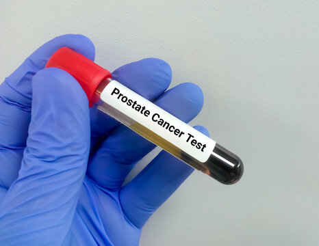 Blood sample tube prostate cancer testing,  PSA and free PSA test