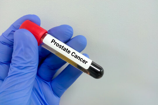 Blood sample tube prostate cancer testing,  PSA and free PSA test