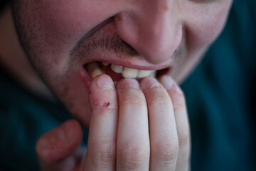 bad habits.Bite the nails. A hand with some ugly nails. disgusting bitten fingernails. Nervous man...