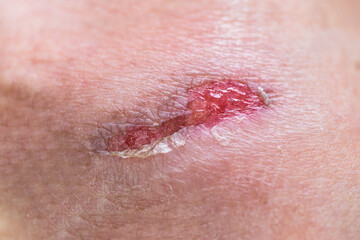 Abrasion with some fluid discharge from a woman's hand