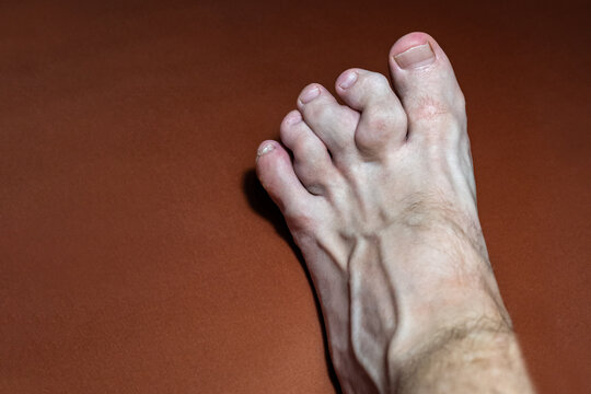 close-up of gouty toes. toes affected by Gout - a disease in which defective metabolism of uric acid causes arthritis. Gout is also known as "the disease of kings" .