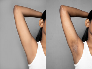 Asian woman with underarm before and after skincare cosmetology armpits epilation treatment...