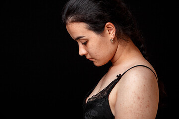 Naklejka premium acne and pimples on the face and body of a young girl. on an isolated background. concept for medicine and cosmetology