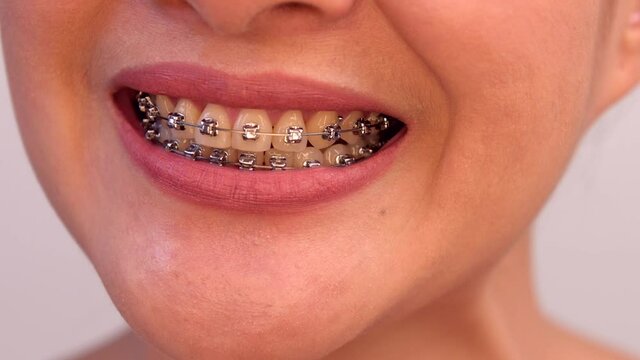 Smiling Asian woman wearing orthodontic retainer. Dental care and healthy teeth.