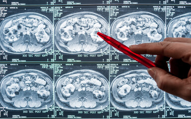 Bild einer Magnetresonaztomographie, MRT,  Computertomographie, Röntgenbild.
Bauchbereich im...