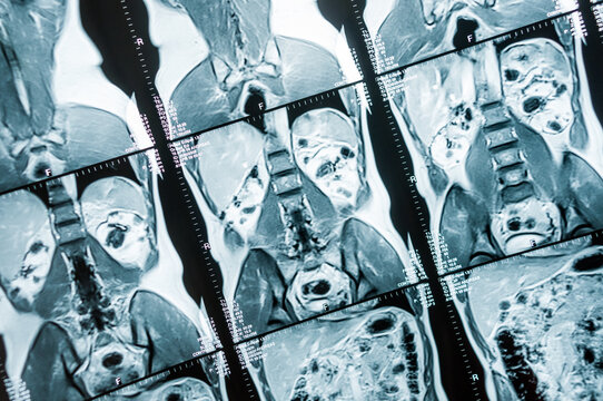 Bild einer Magnetresonaztomographie, MRT,  Computertomographie, R&ouml;ntgenbild.
Bereich des Becken mit Nieren, die von Tumoren befallen sind.