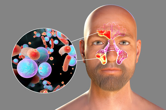Purulent inflammation of frontal and maxillary sinuses in a man and close-up view of bacteria that cause sinusitis