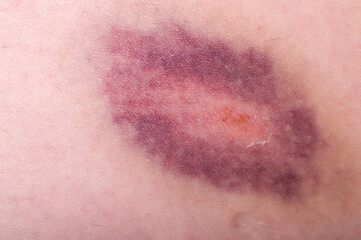 Closeup on a Bruise on wounded leg skin