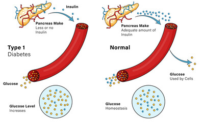 Illustration of mechanism of Type 1 Diabetes.