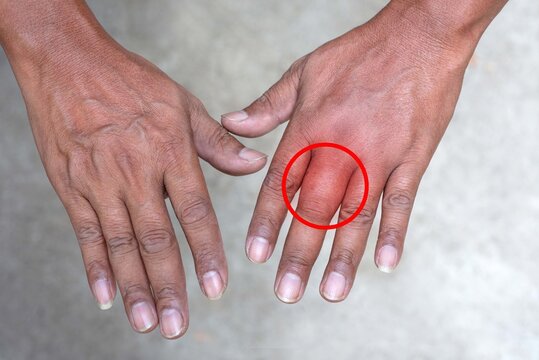 Male person showing swollen fingers due to insect bites, selective focus at swollen hand with bug bite and red skin, red graphics on swollen hand positions