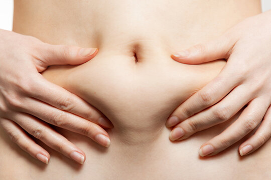 A woman holds her hands to her stomach, pulling the skin with fat. Close-up of the abdomen and navel. The concept of obesity, weight loss and liposuction