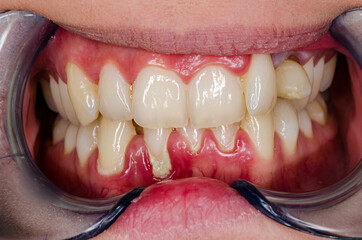 close up of teeth with gingivitis