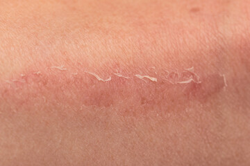 scratch on the skin of the leg as a background