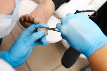 Podiatrist for the treatment of feet and nails, removes the inflamed infected nail, fungus disease.