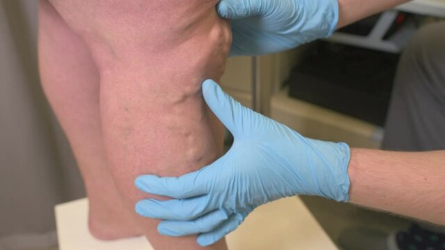 phlebologist or vascular surgeon examines the varicose veins of the lower extremities of a patient in a modern dermatological clinic.