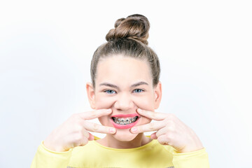 Girl stretches her mouth with fingers showing dental braces. Concept of dentistry and installation of braces.