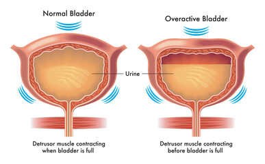 Medical illustration compares a normal bladder to an overactive bladder, with annotations. - obrazy, fototapety, plakaty