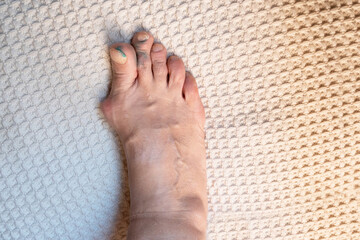 deformed toes after multiple fractures. swelling of the joints of the toes. Painful gout...