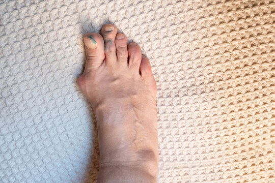 deformed toes after multiple fractures. swelling of the joints of the toes. Painful gout inflammation on toe joints, selective focus.