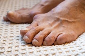 warped, cracked and scratched nails on the feet of an elderly woman. deficiency of vitamins and minerals, which leads to problems with nails and skin.