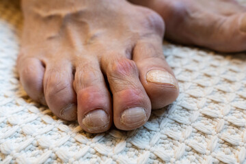 close-up of gouty toes. toes affected by Gout - a disease in which defective metabolism of uric...