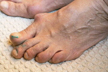 inflamed and deformed joints on the toes  of middle aged lady due to arthritis or gout, close-up,...