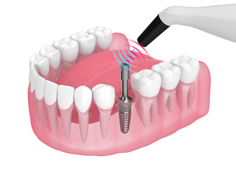 Checking dental implant stability by osseointegration monitoring device