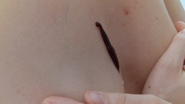 Hirudo medicinalis are widely used all around the world today and in the past in healing, rejuvenation, cure diseases in organs. They thin blood with saliva, sucking out infected and dirty lymph