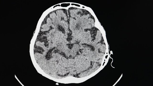 Multi screens CT cine scan of a patient with weakness of legs  showing severe brain atrophy with lacuna infartion involving bilateral lentiform neucleus in the brain.