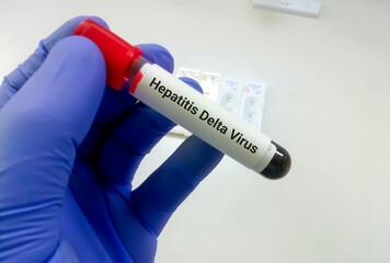 Obraz premium Blood sample for hepatitis Delta virus test