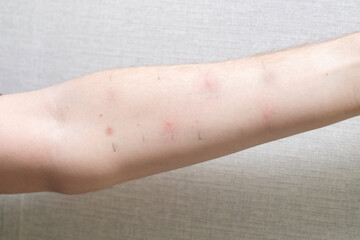 Hand with positive allergy tests. Allergy tests on the arm