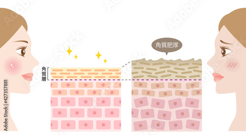 角質肥厚 健康な肌 断面図と女性 Wall Mural Wallpaper Murals Yomogi