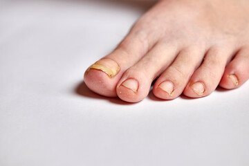 Toenails are affected by the fungus.