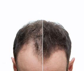 Vorher Nachher - Halbglatze eines Mannes mit Haarausfall	von vorne
