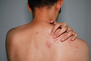 Naklejka premium Close up view of man scratching his back .Painful back skin rash with blisters in a limited area.A man who having varicella blister , chickenpox,Herpes zoster or Shingles.
