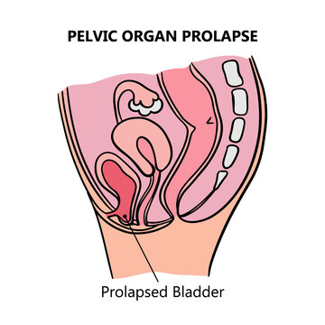 Uterine Prolapse Images – Browse 453 Stock Photos, Vectors, and