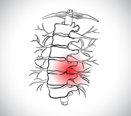 Herniated disc images can cause severe back pain that can lead to paralysis.