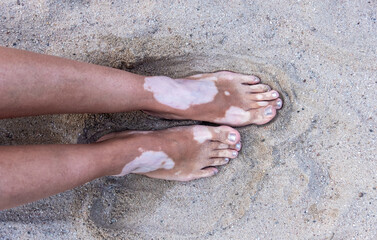 Legs and feet of woman with vitiligo pigment spot disease in the sand, copy space