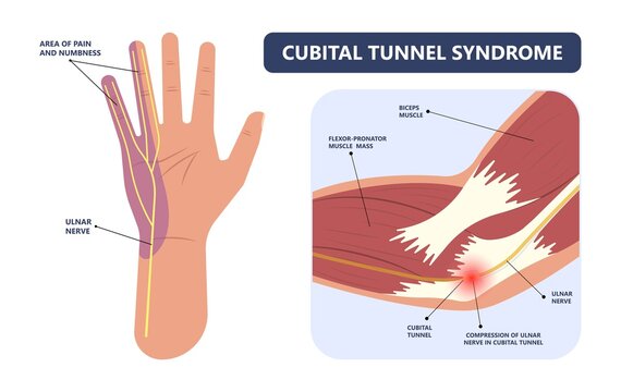 ulnar nerve muscle bone elbow swollen pain hand palm bone spurs ring little medial golfer radial arms wrist funny carpal tennis canal palsy test