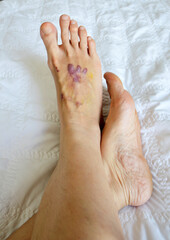 Accident scar on foot, purple skin scar, in white bed background