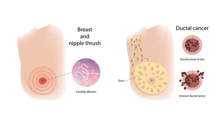Woman breast and nipple thrush, ductal cancer. Comparison. Medical vector illustration.