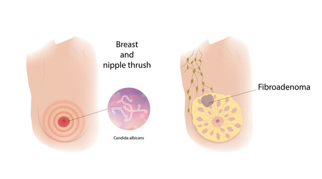 Woman breast and nipple thrush, Fibroadenoma. Comparison. Medical vector illustration.