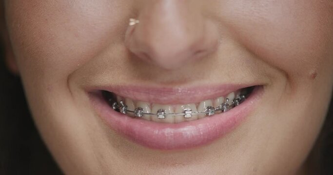 Teeth alignment by braces. Close up of female friendly smile. Dental care, orthodontic treatment. Correction of overbite