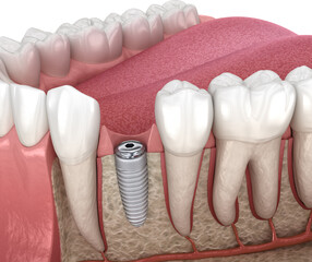Cover screw and dental implant. Medically accurate 3D illustration.