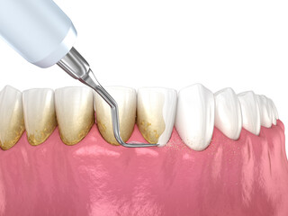 Fototapeta na wymiar Oral hygiene: Scaling and root planing (conventional periodontal therapy). Medically accurate 3D illustration of human teeth treatment